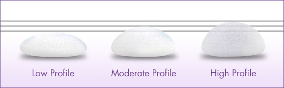 alt="infographic comparing low, moderate, and high profile implants"