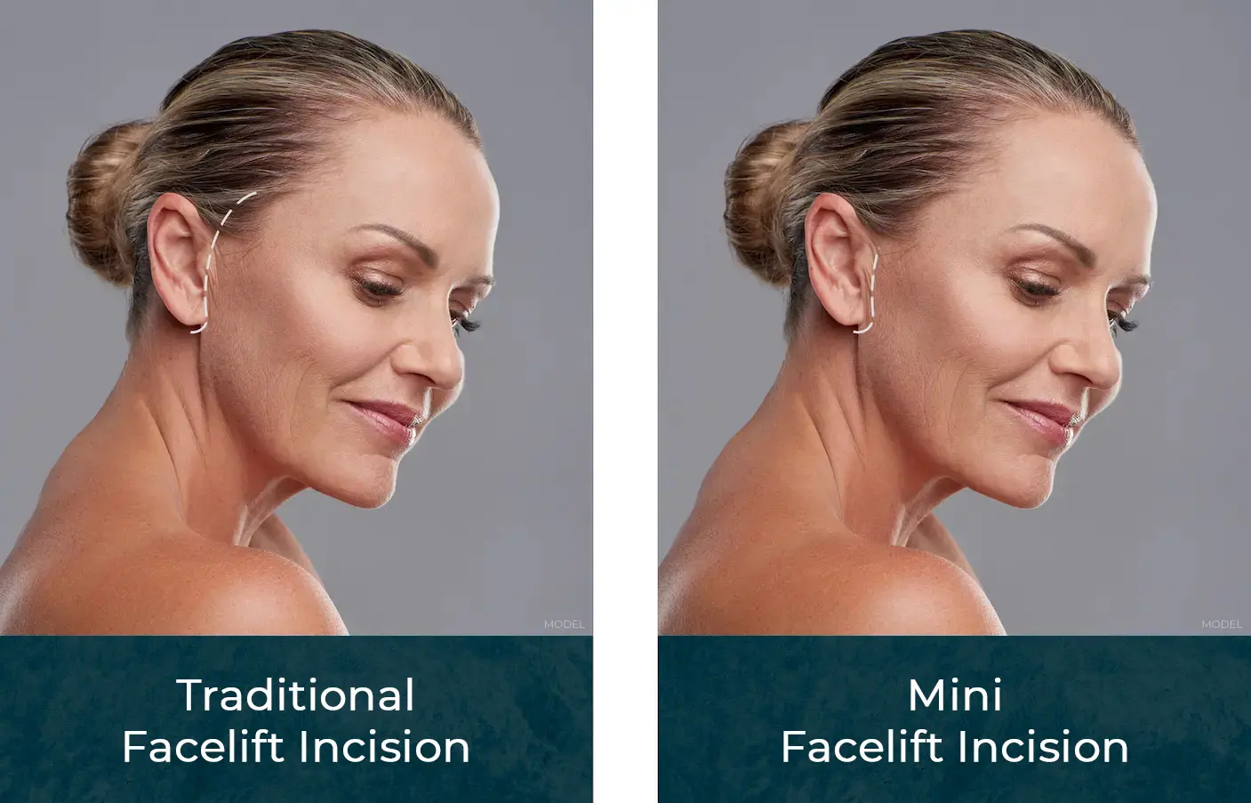 Traditional and mini face incisions