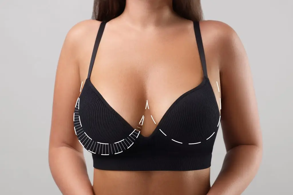 Explore options for a breast lift in San Jose with Reveal Plastic Surgery. Get expert guidance to achieve your desired results and regain your confidence.